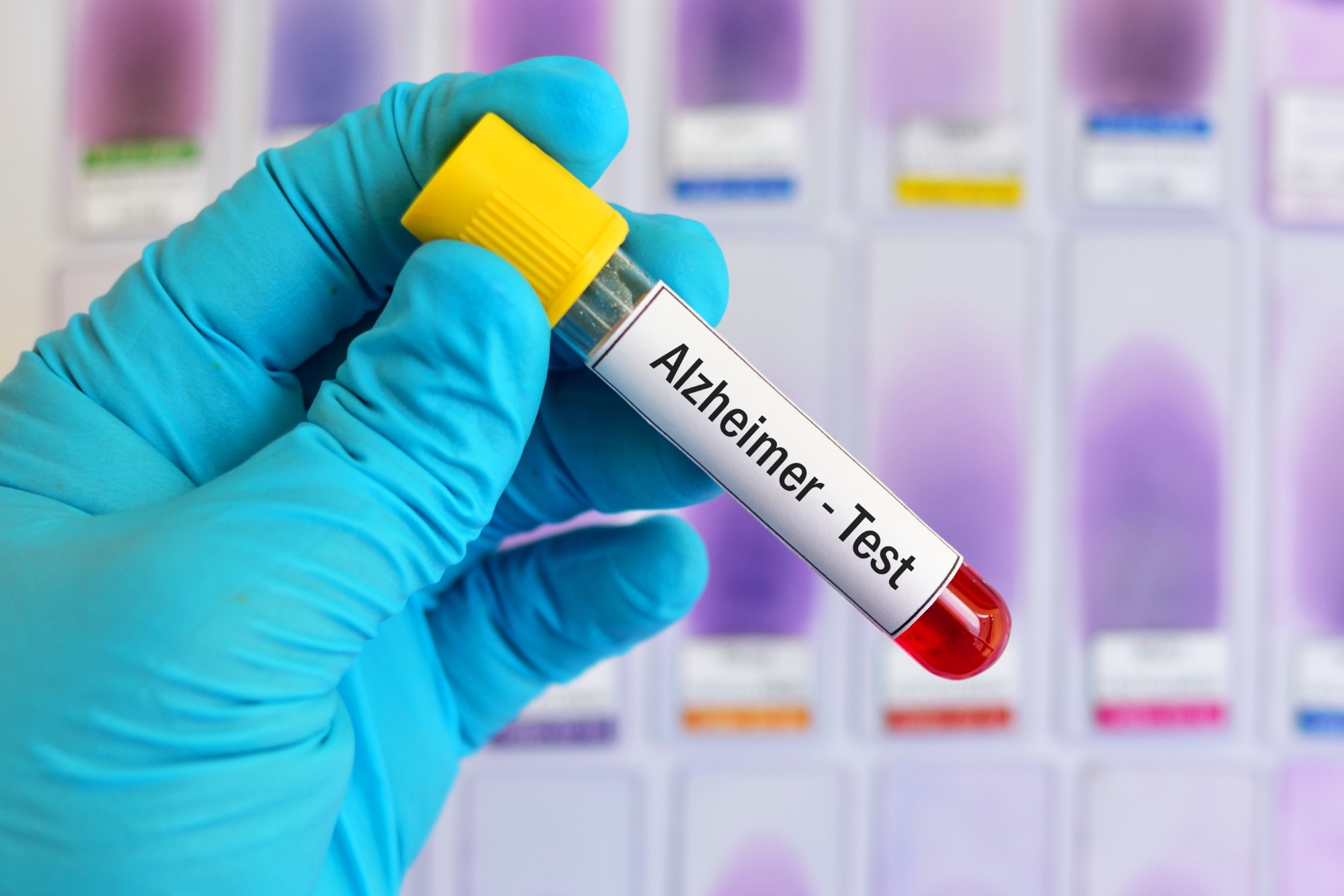 A Blood Test Can Help Confirm Alzheimer’s